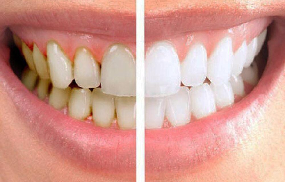 Sbiancamento dentale: il segreto per un sorriso più luminoso